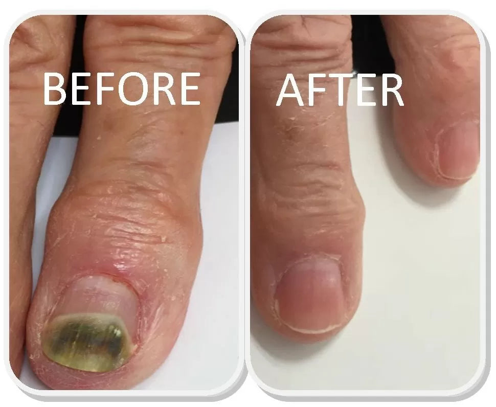 FAST NAIL FUNGUS TREATMENTS NAIL REPAIR ESSENCES SERUM